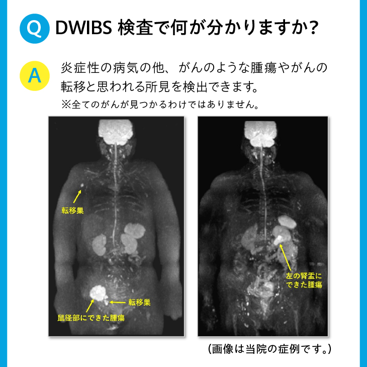 全身MRI (DWIBS) がん検診利用券 [BM001]