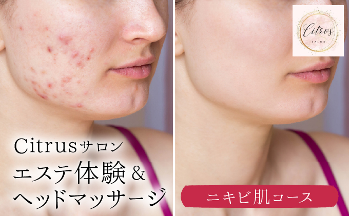 ニキビ肌コース（陶肌トリートメント＋ビタミンC〈VCF〉とヘッドマッサージ）　350P8403