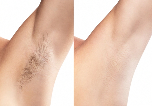 【メンズ脱毛】全身脱毛※VIO全顔付き | 体験 施術 メンズ 全身脱毛 VIO 脱毛 茨城県 古河市 関東 _FL03