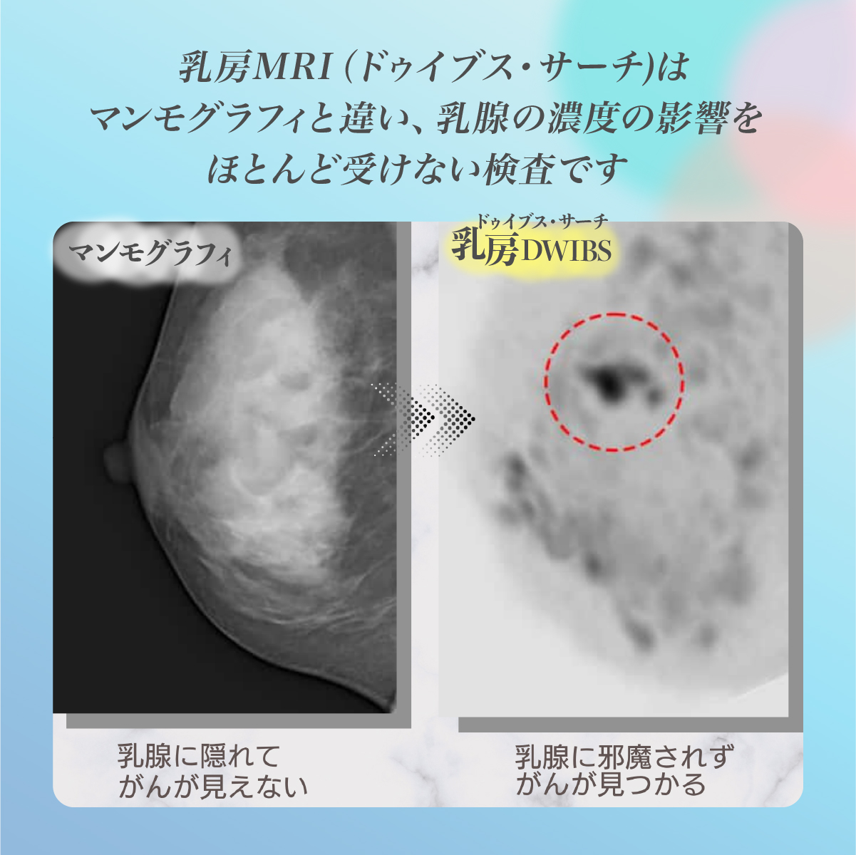 乳房DWIBS (痛くないMRI乳がん検診) チケット 永仁会シーズクリニック