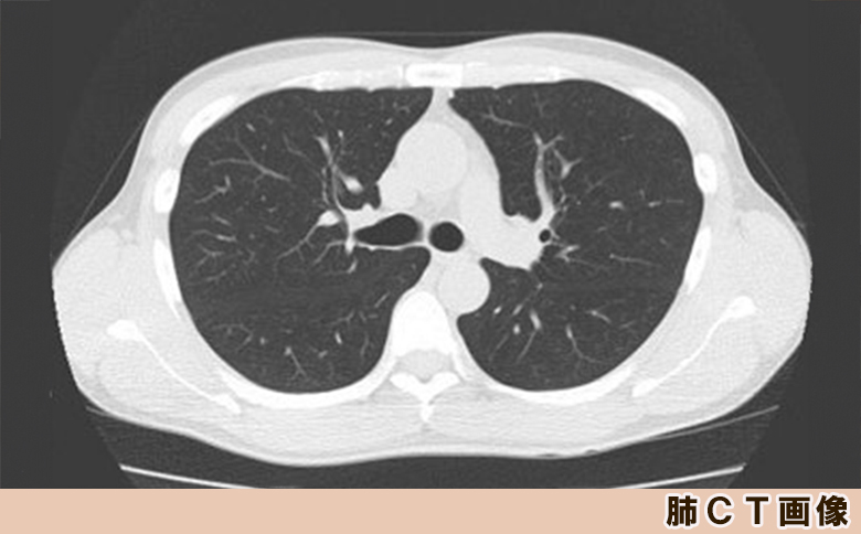【亀田クリニック人間ドック】肺CT検査（肺がん検診）コース　１名様（単独）　[0055-0002] 肺CT検査