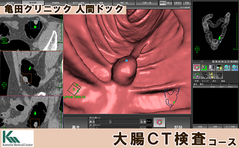 【亀田クリニック人間ドック】大腸CT検査コース　１名様（単独）　[0130-0001] 大腸CT検査