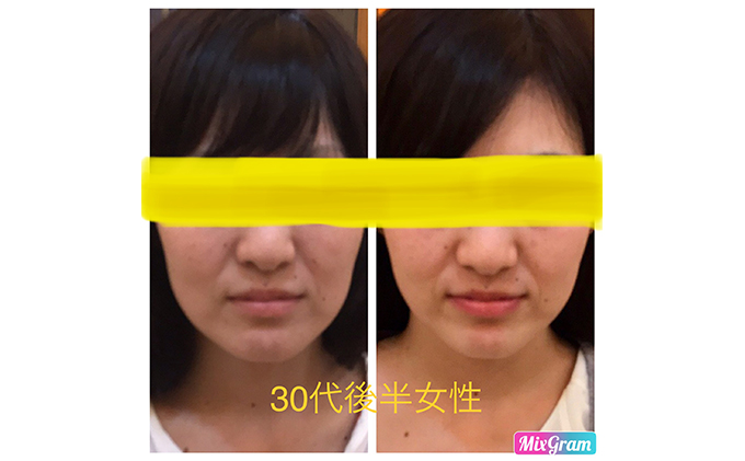 小顔矯正コルギチケット×10回