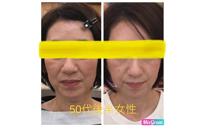 小顔矯正コルギチケット×10回