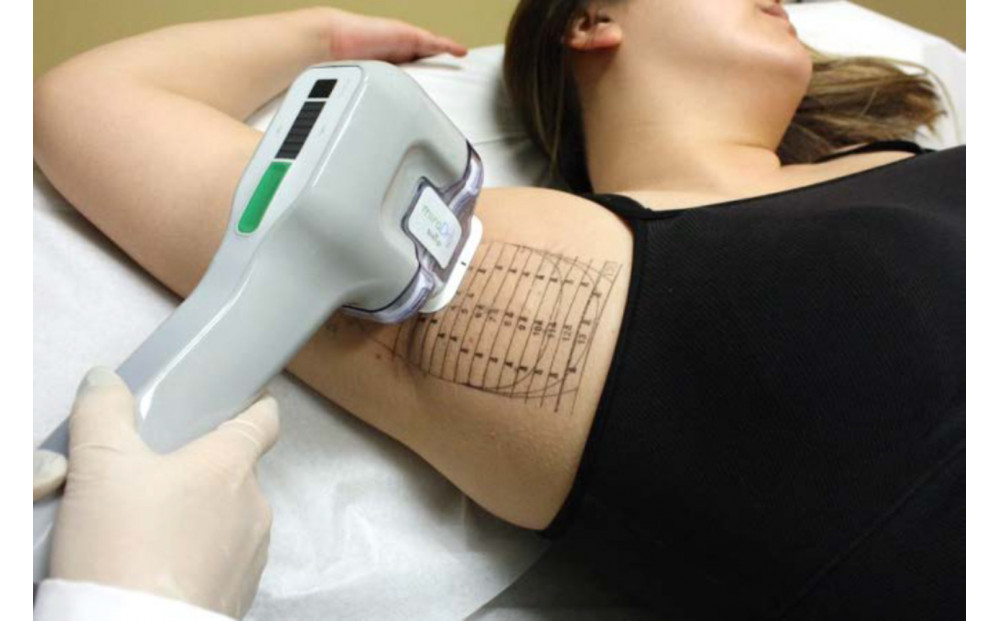 【切らないワキガ治療】ミラドライ（両脇）【シングル照射】広範囲照射