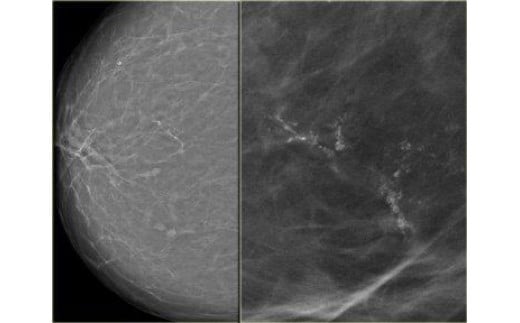 マンモグラフィー＋乳房エコー検査 マンモグラフィー＋乳房エコー検査