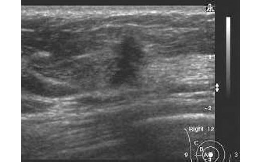 マンモグラフィー＋乳房エコー検査 マンモグラフィー＋乳房エコー検査