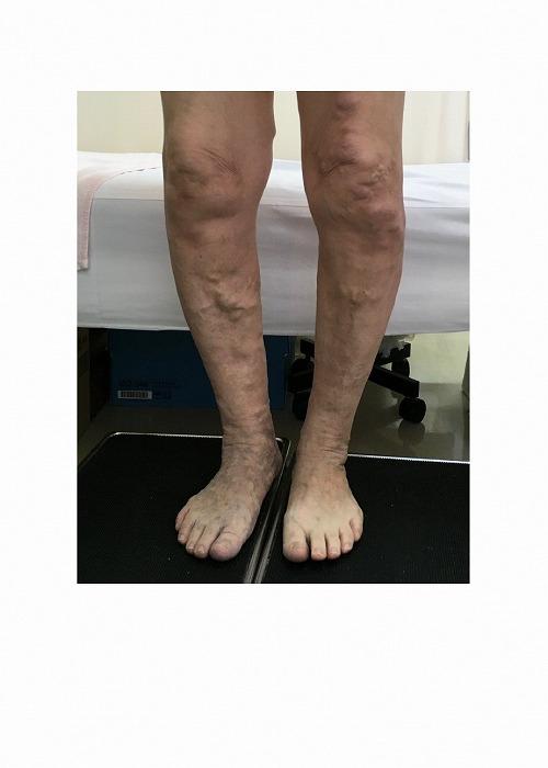 下肢静脈瘤検査