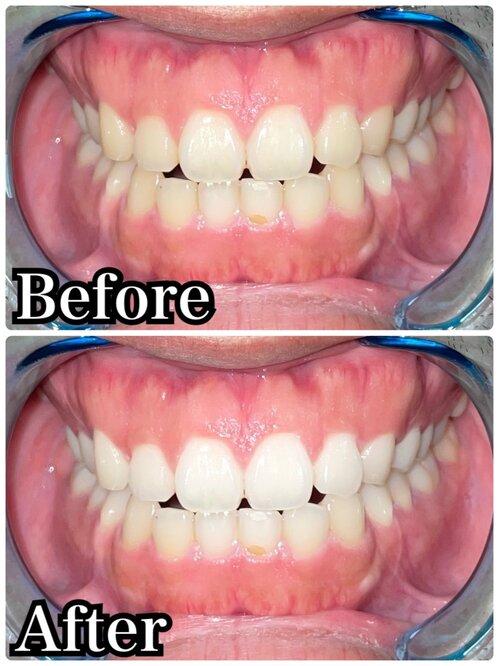 レクシルラボ　ホワイトインフィニティ プレミアム　ホームホワイトニング