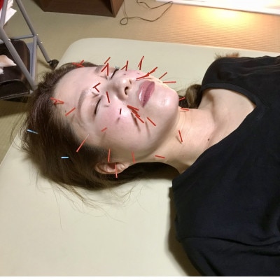 【話題】お試し美容鍼/はりフェイスケア体験チケット