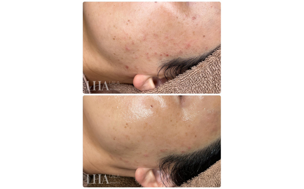 美容鍼＋ララピール （1回体験）